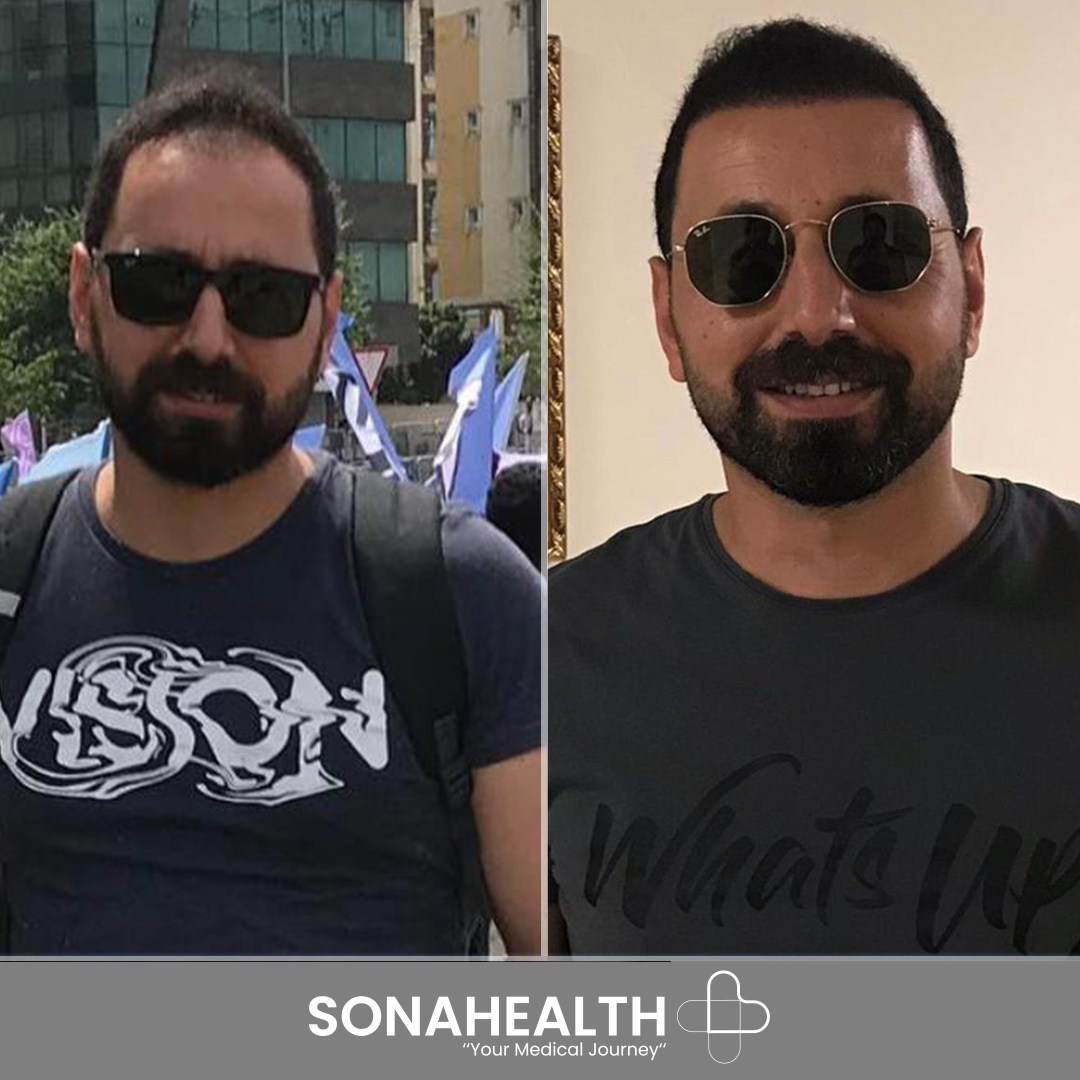 1_sona before after