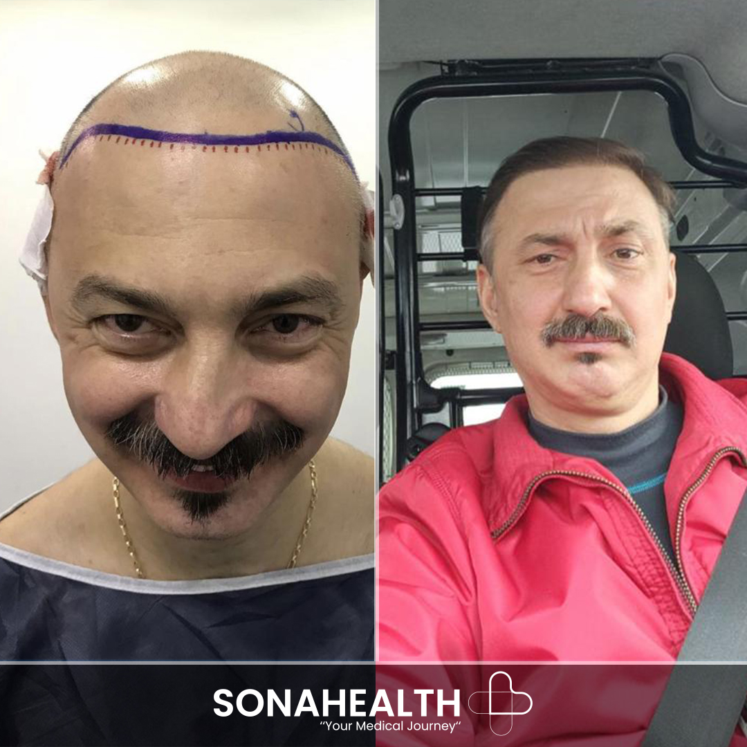 4_sona before after