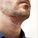 beard transplant in istanbul