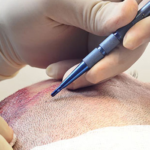 sapphire hair transplant istanbul