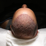 Hair Transplant Prices in Istanbul
